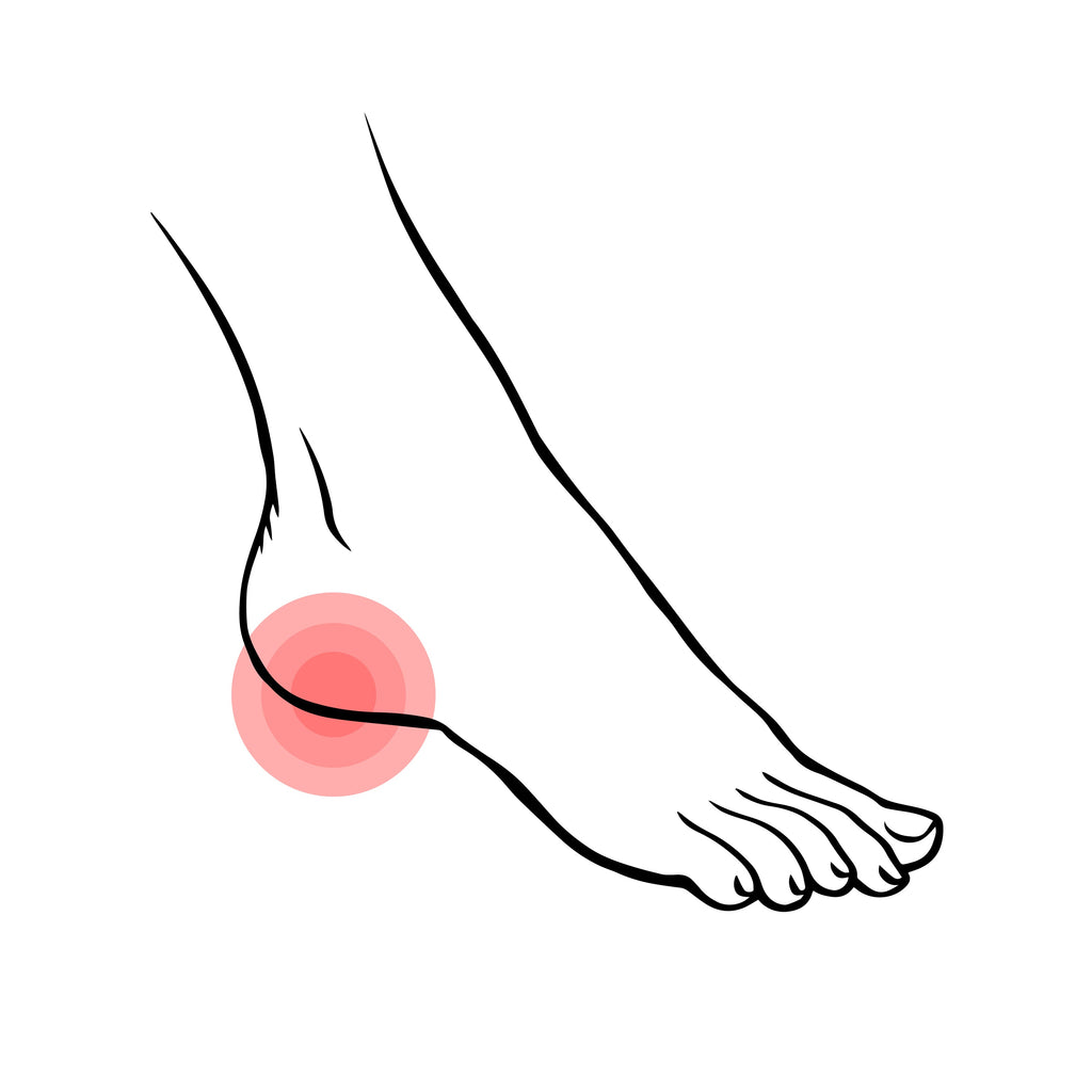 Plantar Fasciitis